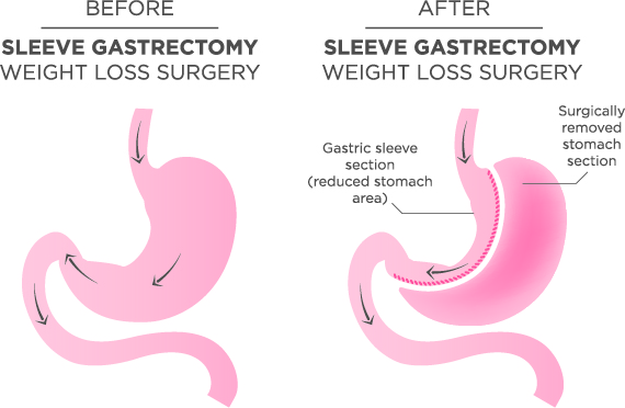 gastric sleeve surgery Melbourne 