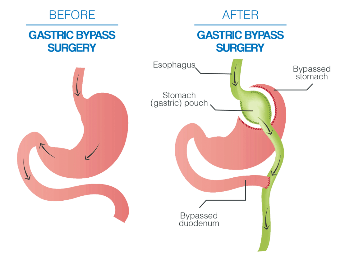 melbourne gastric bypass surgery