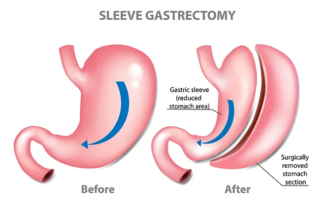 gastric sleeve surgery melbourne