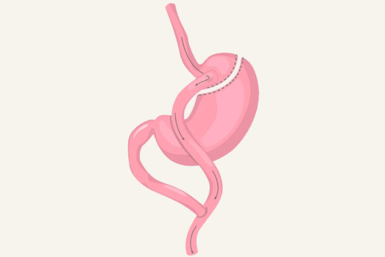 gastric bypass melbourne